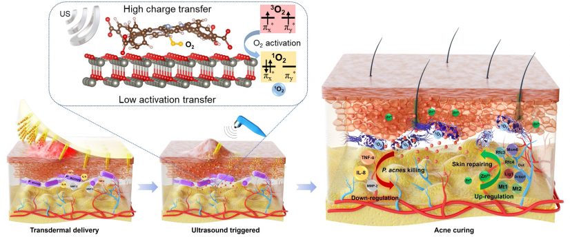 Treatment of acne through efficient ultrasound-triggered antibacterial nanoparticles embedded microneedle patch.
 